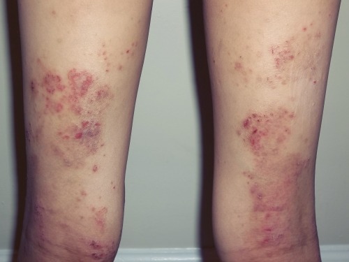 eczema