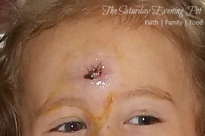 stitches